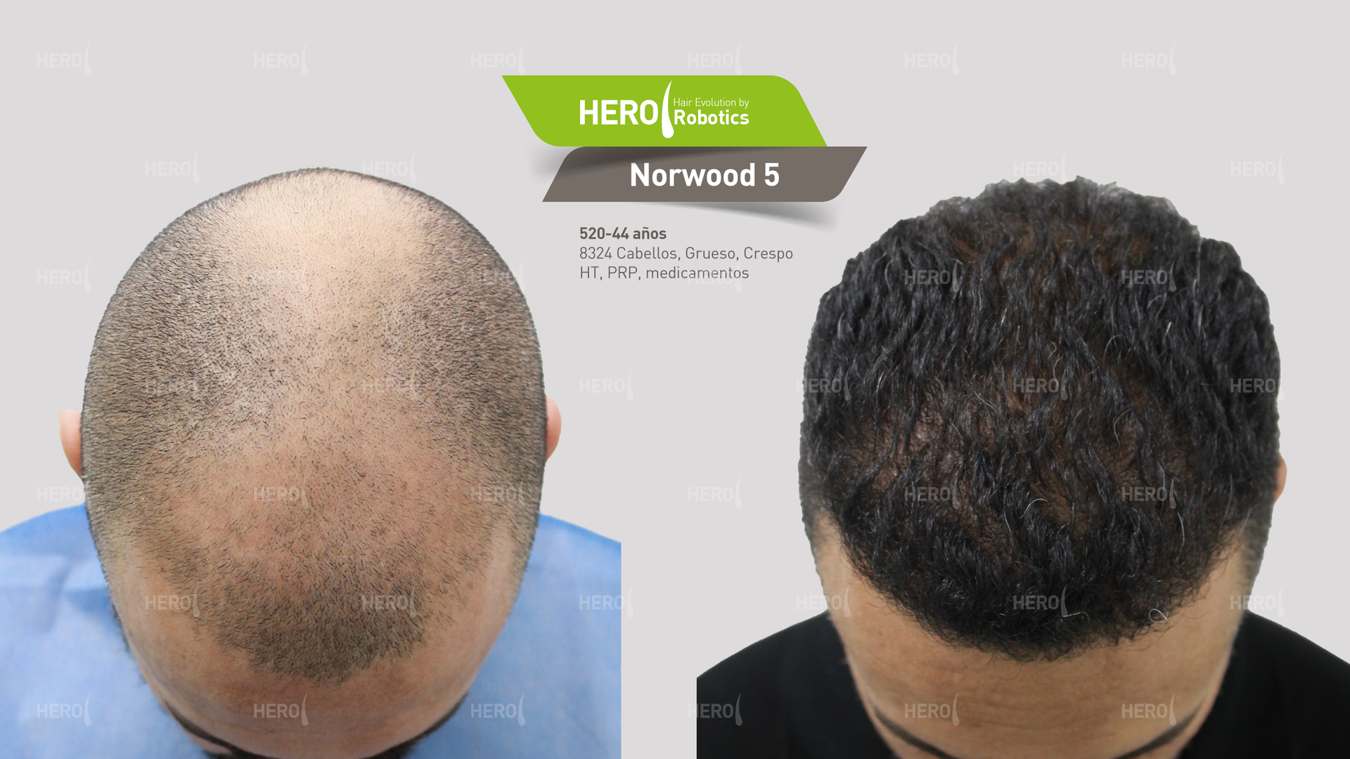 A before and after picture of a man 's hair growth.