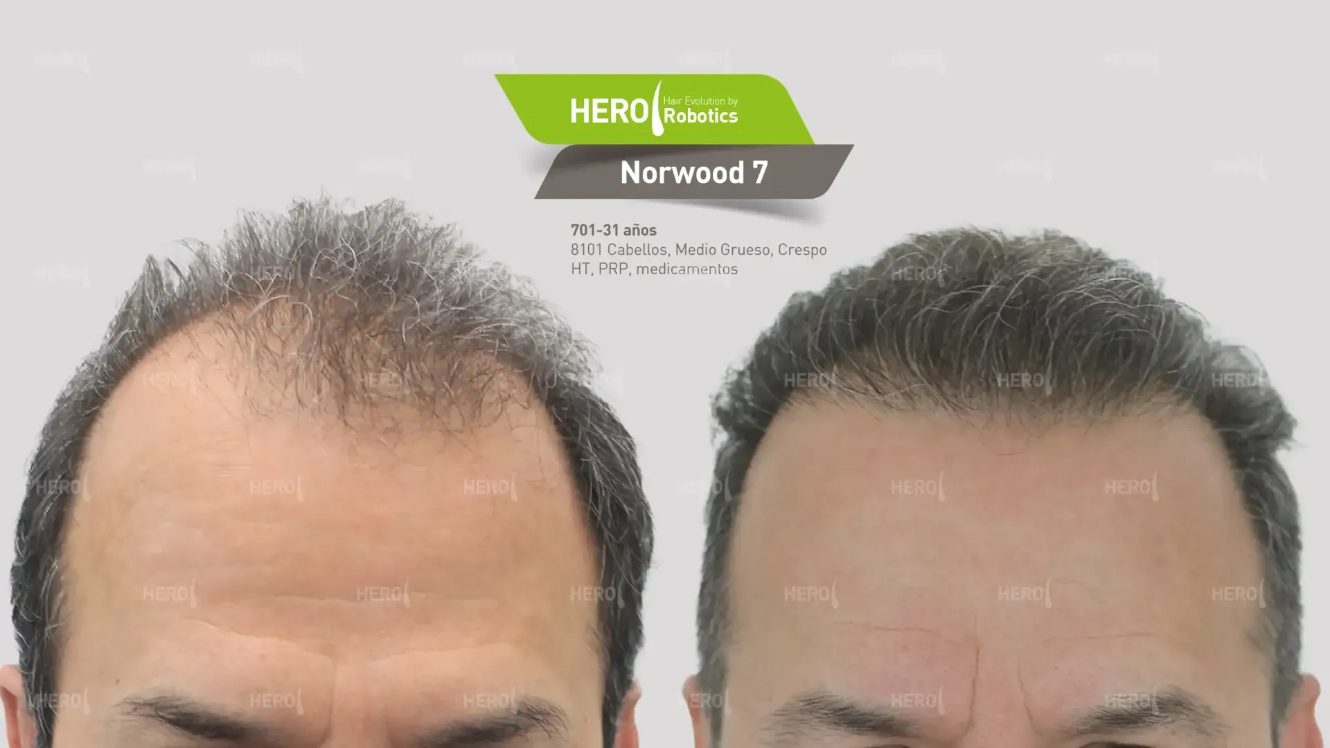 A before and after picture of a man's head with hair loss. Norwood 7.