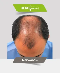 Una cabeza de hombre antes de un injerto capilar
