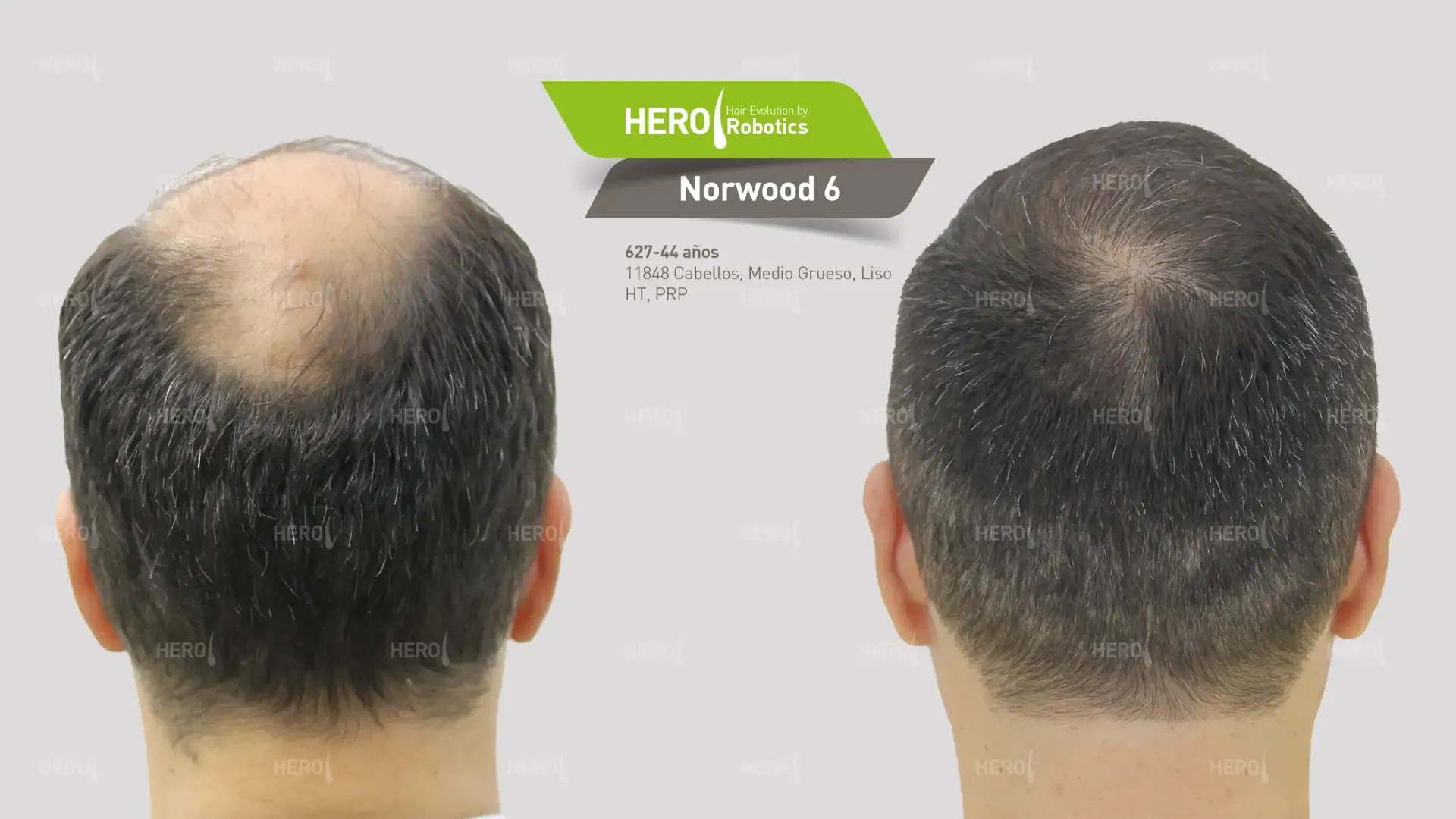 Antes y después de trasplante capilar hombre con alopecia Norwood 6