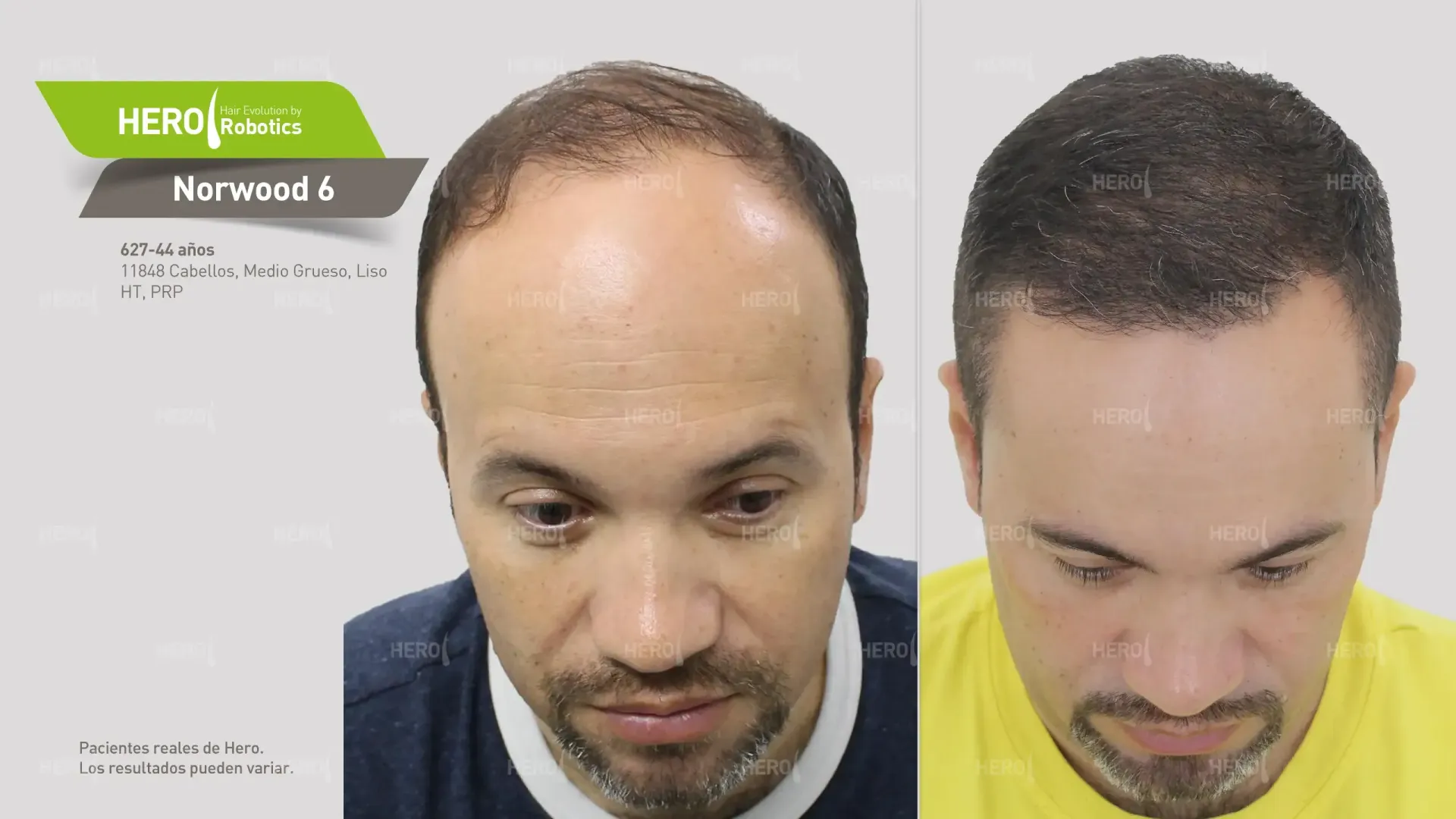 Antes y después de trasplante capilar hombre con alopecia Norwood 6
