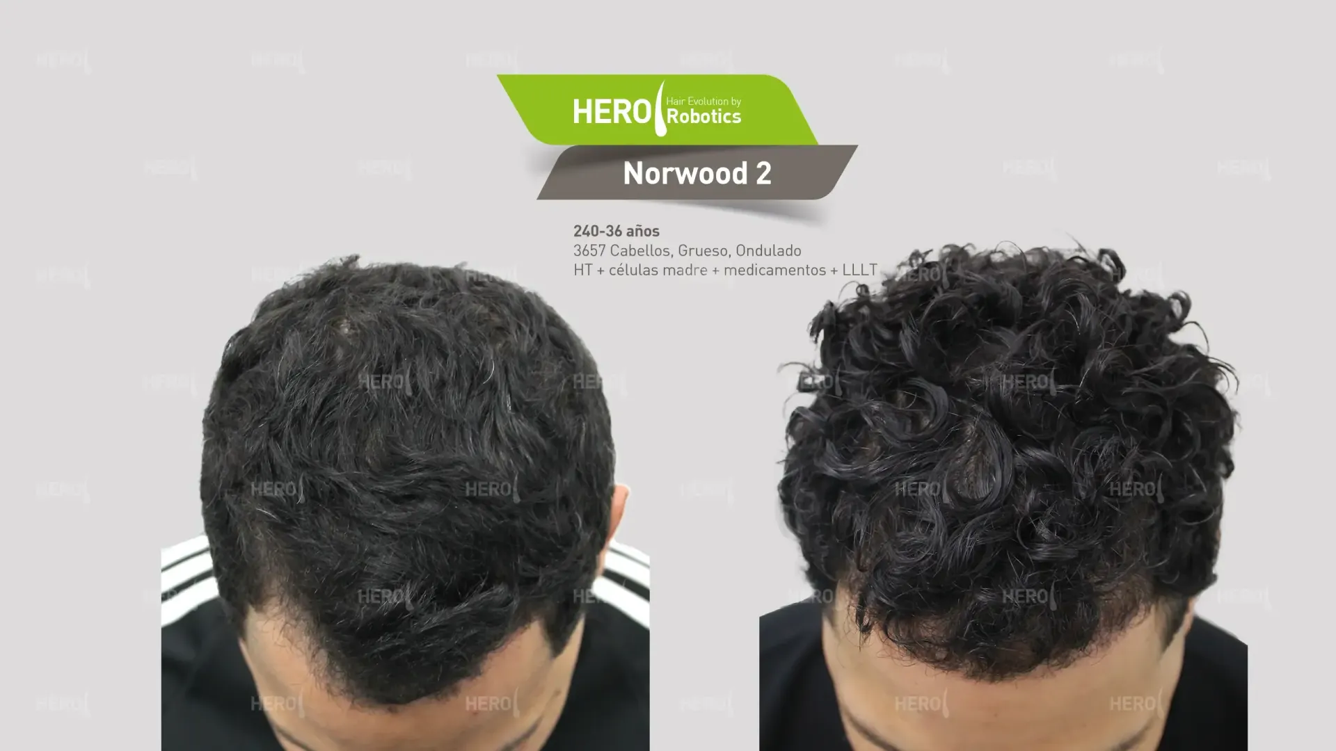 A before and after photo of a man 's hair growth. Norwood level 2