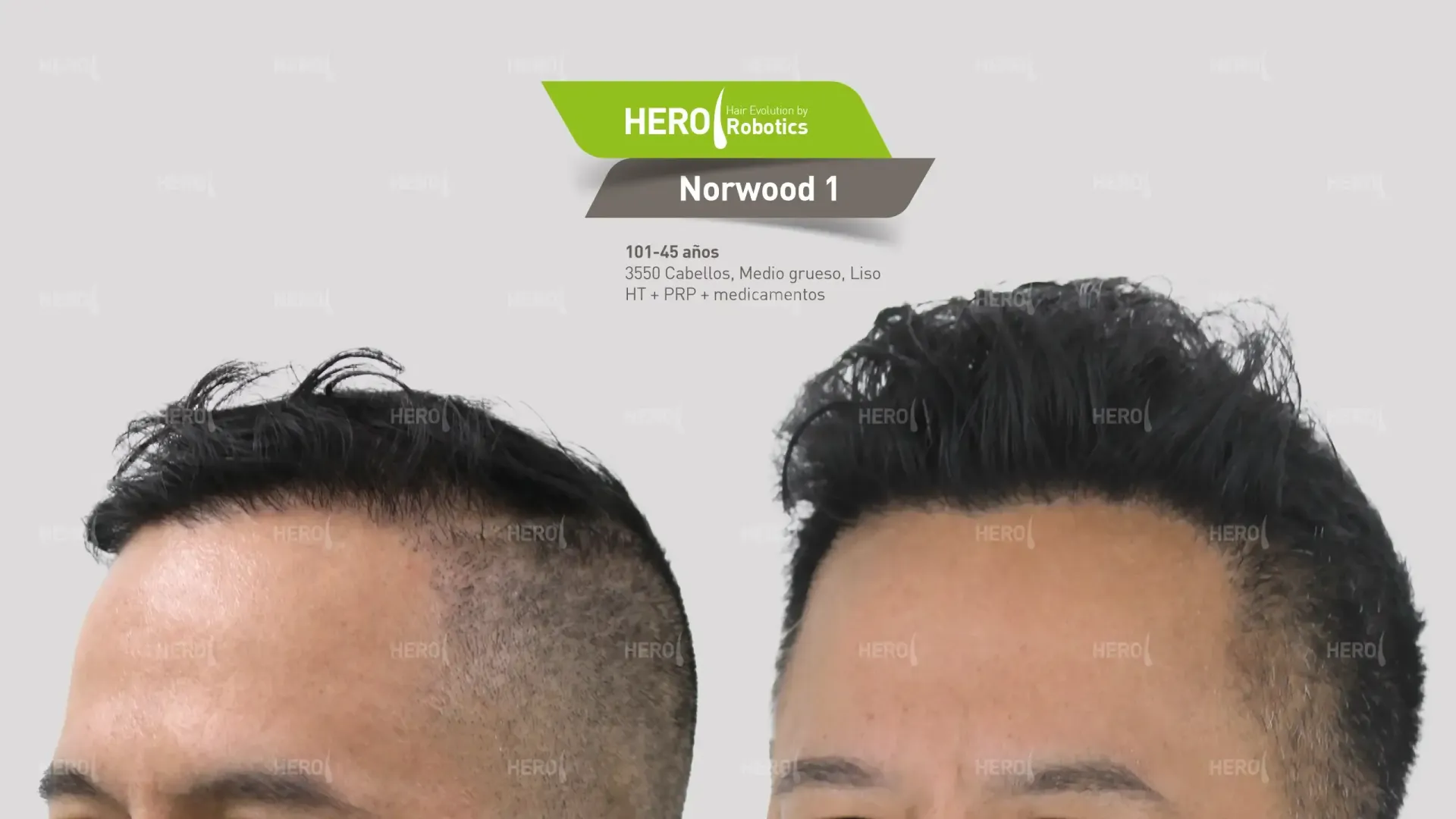 A before and after photo of a man's hair, Norwood level 1