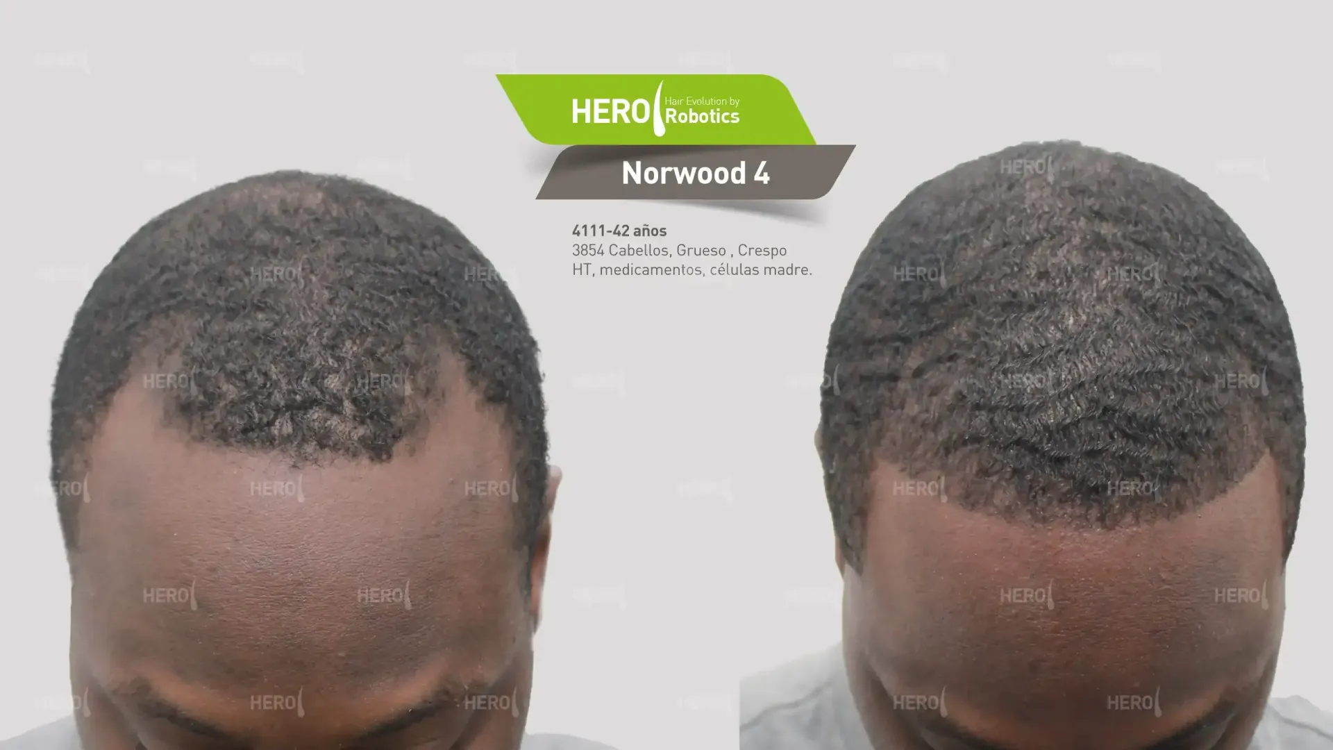 A before and after picture of a man 's hair
