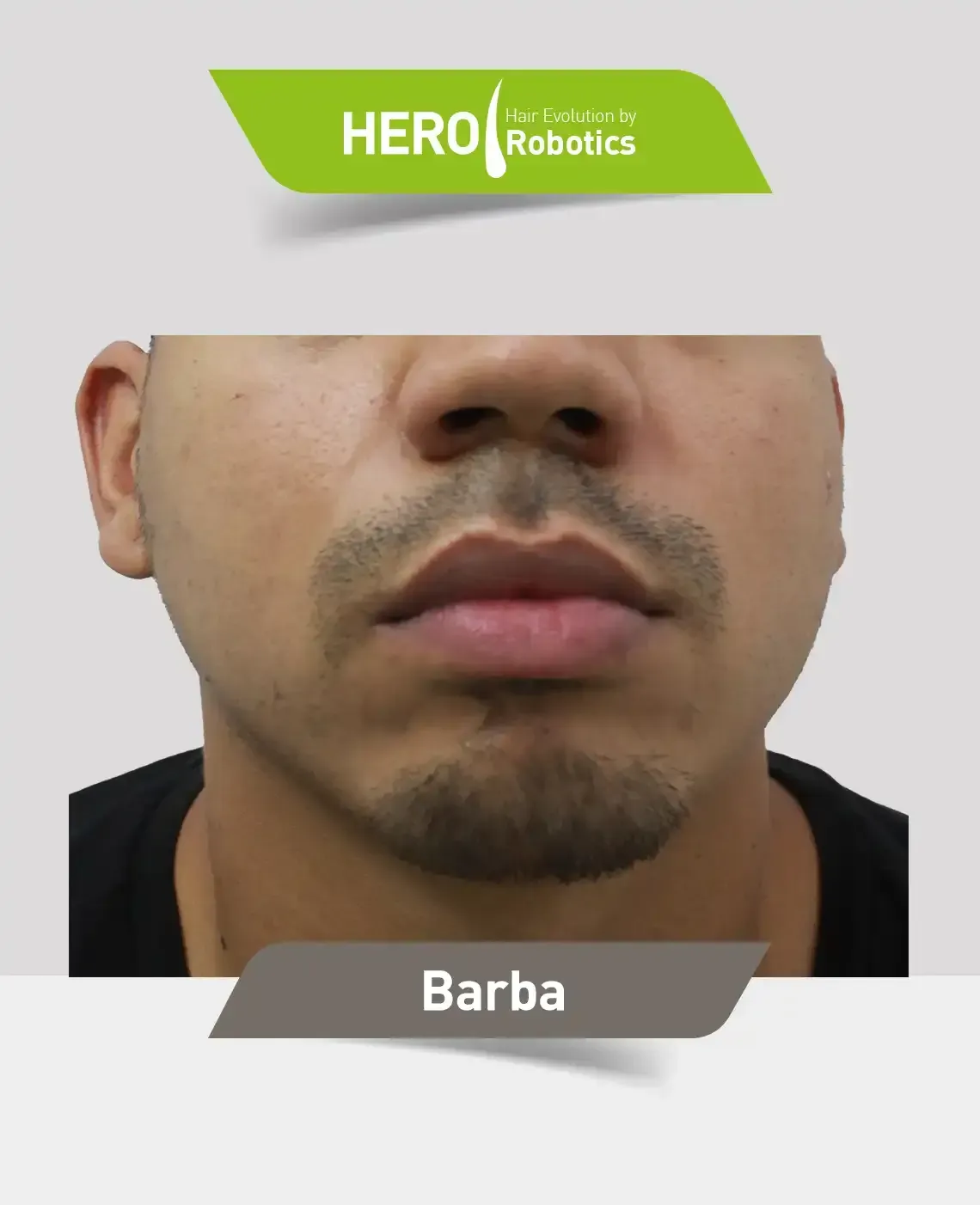 Una cabeza de hombre antes de un injerto capilar en barba