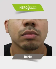 Una cabeza de hombre antes de un injerto capilar en barba