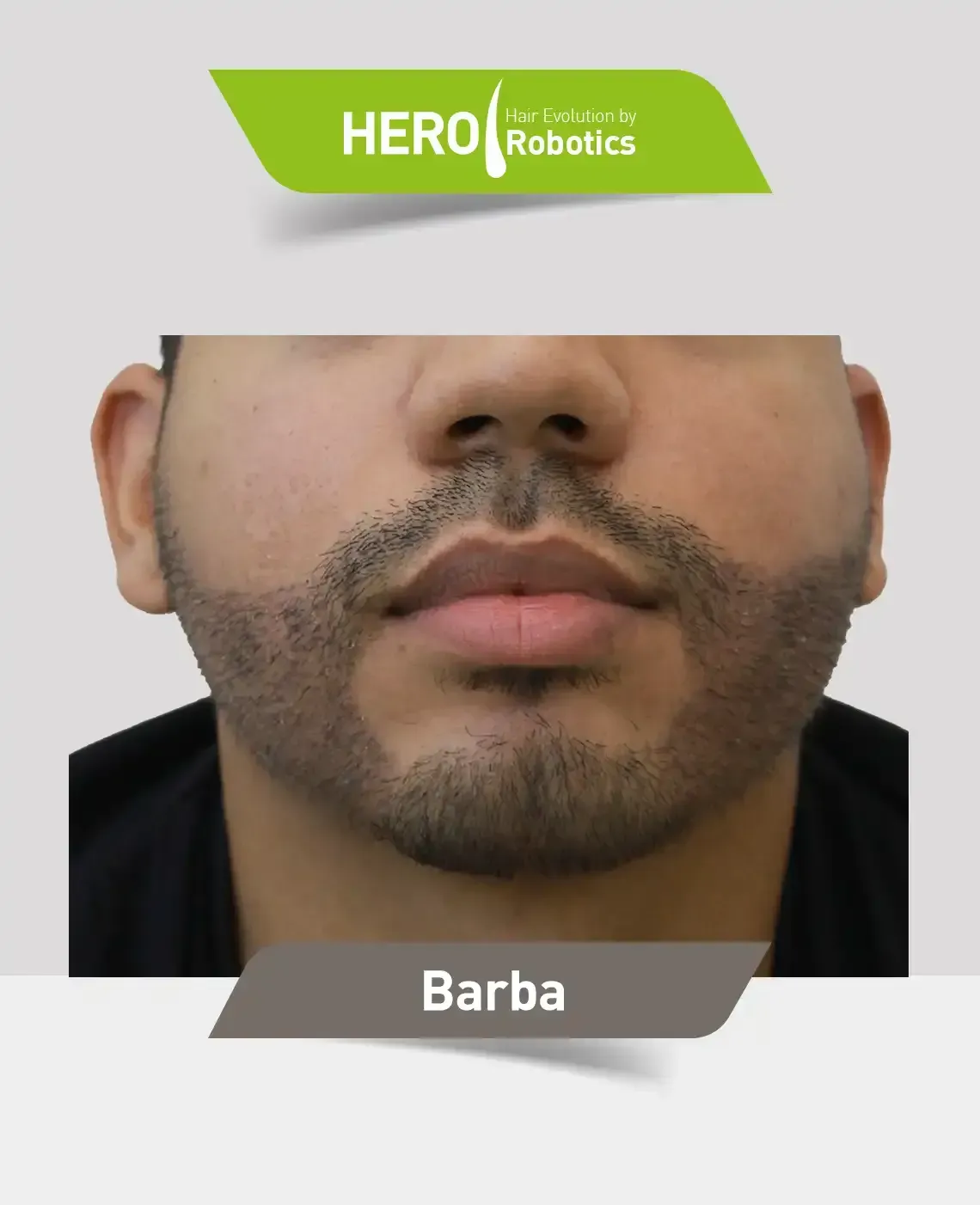 Una cabeza de hombre después de un injerto capilar en Barba