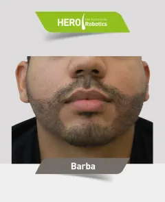 Una cabeza de hombre después de un injerto capilar en Barba