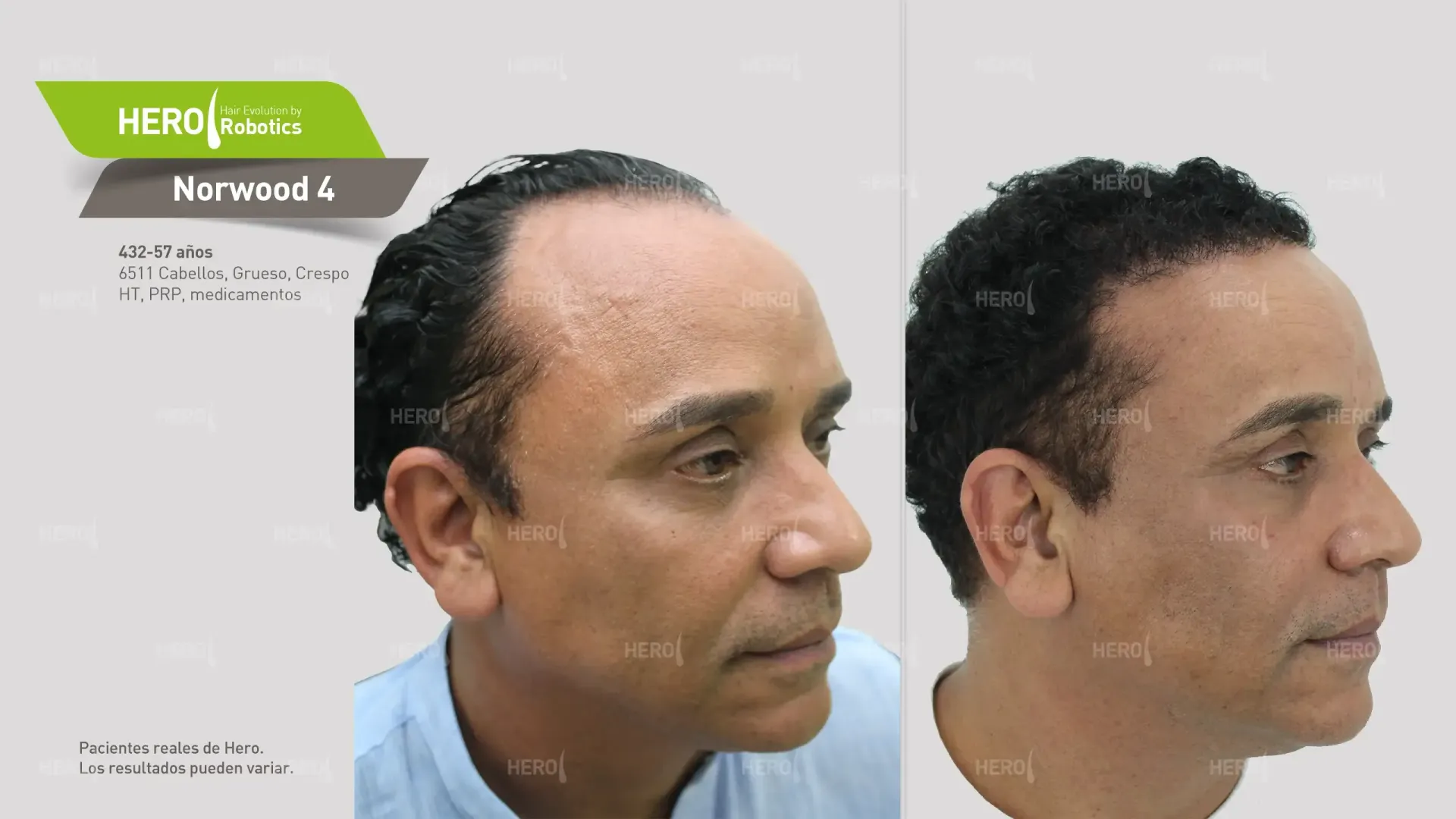 Una fotografía de antes y después del crecimiento del cabello de un hombre Norwood 4.