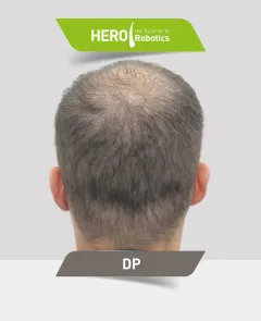 Una cabeza de hombre antes de un injerto capilar en barba