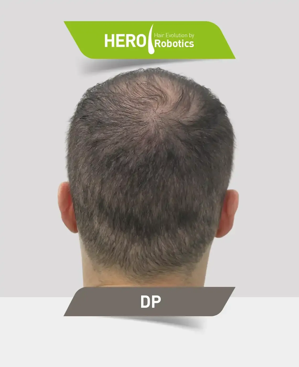 Una cabeza de hombre después de un injerto capilar en Barba