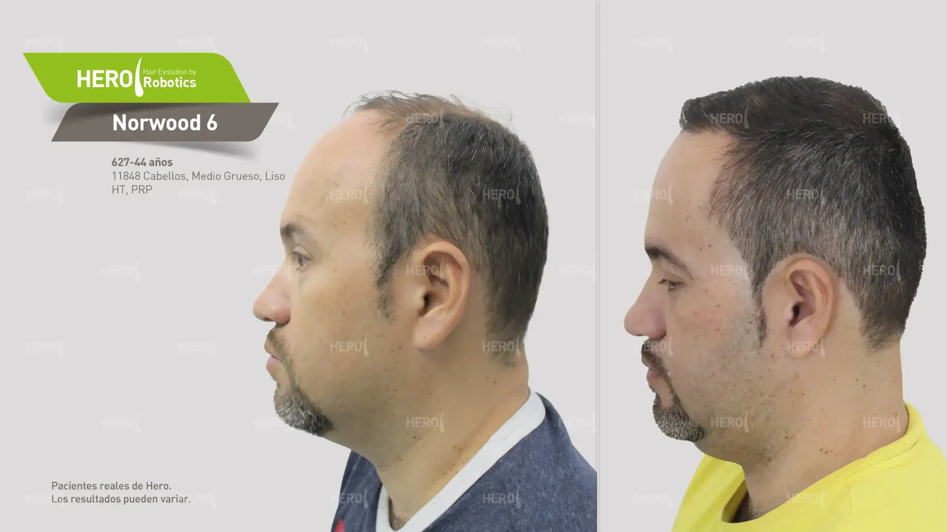 Antes y después de trasplante capilar hombre con alopecia Norwood 6