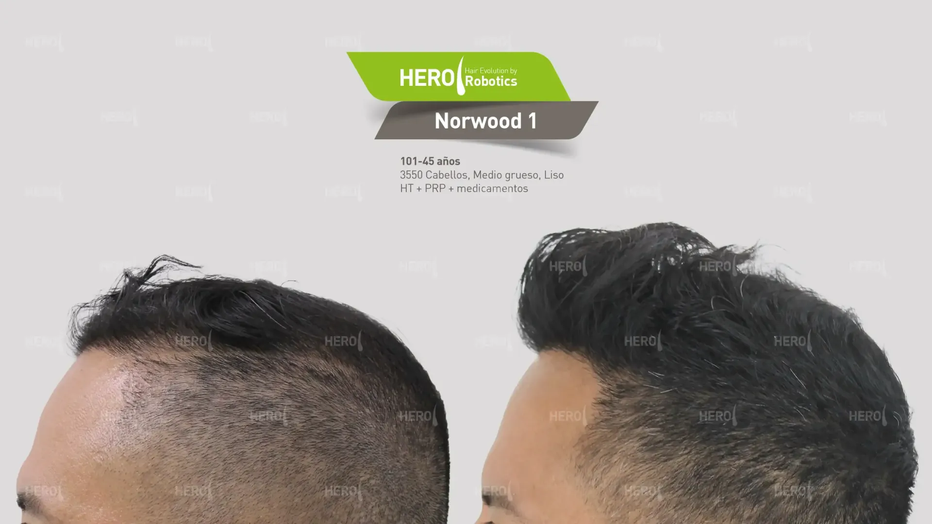 A before and after photo of a man's hair, Norwood level 1