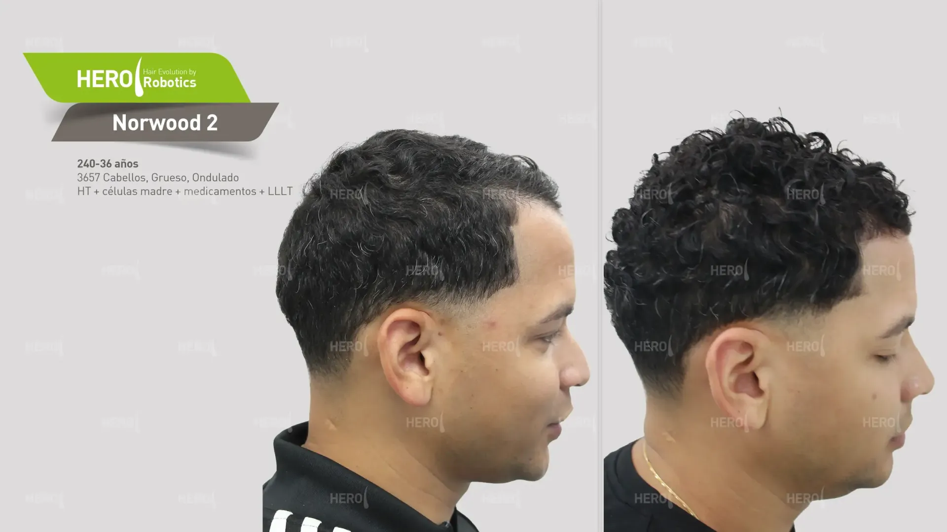 A before and after photo of a man 's hair growth. Norwood level 2
