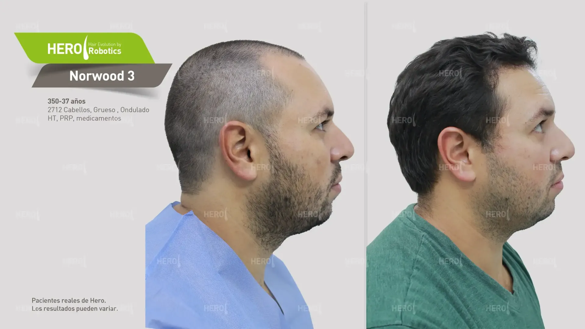 Nivel 3 de Norwood: Abordando el Adelgazamiento Temprano del Cabello