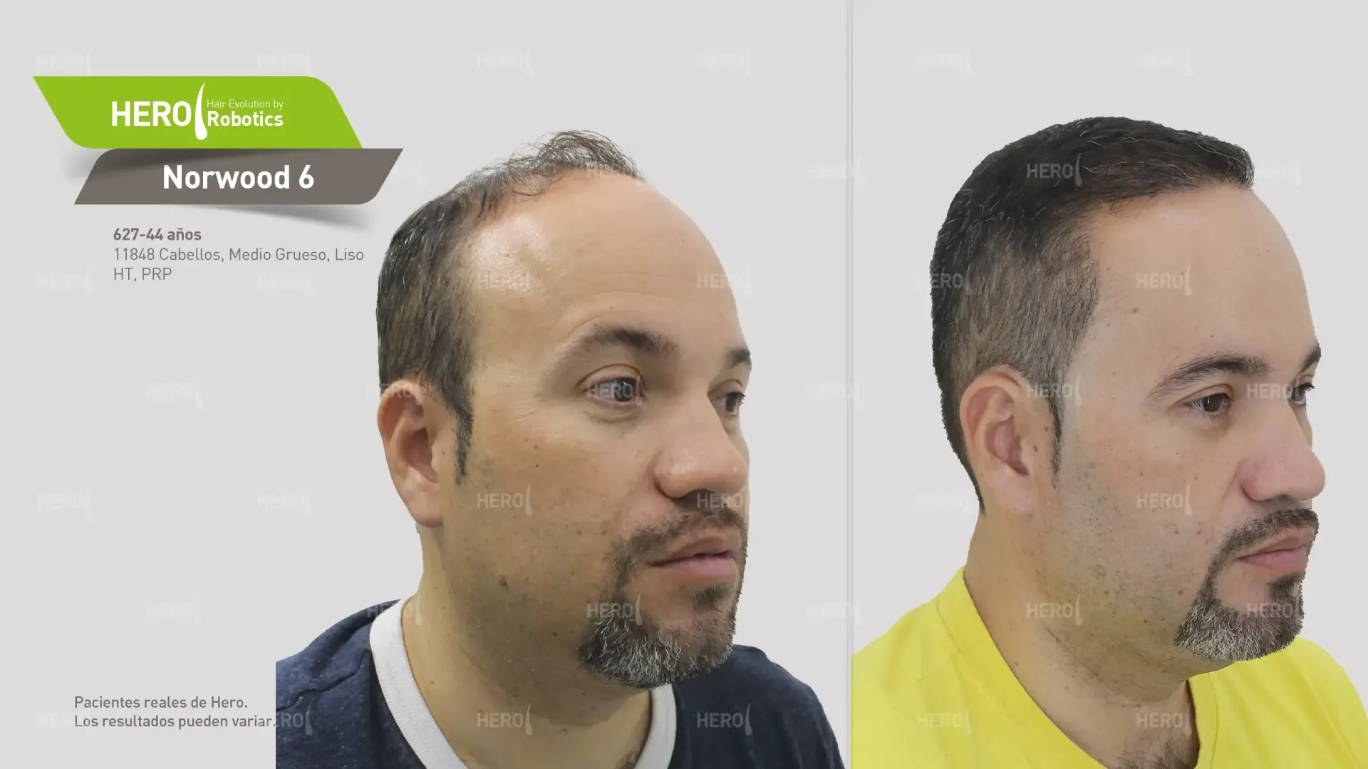 Antes y después de trasplante capilar hombre con alopecia Norwood 6