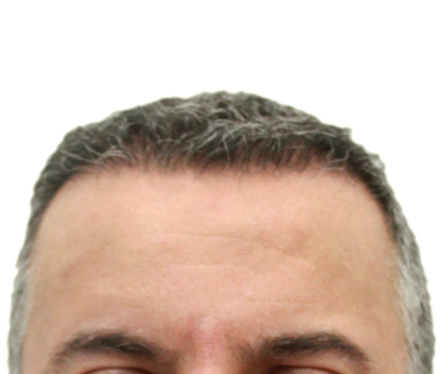After hair restoration | Real patient, results may vary per individual