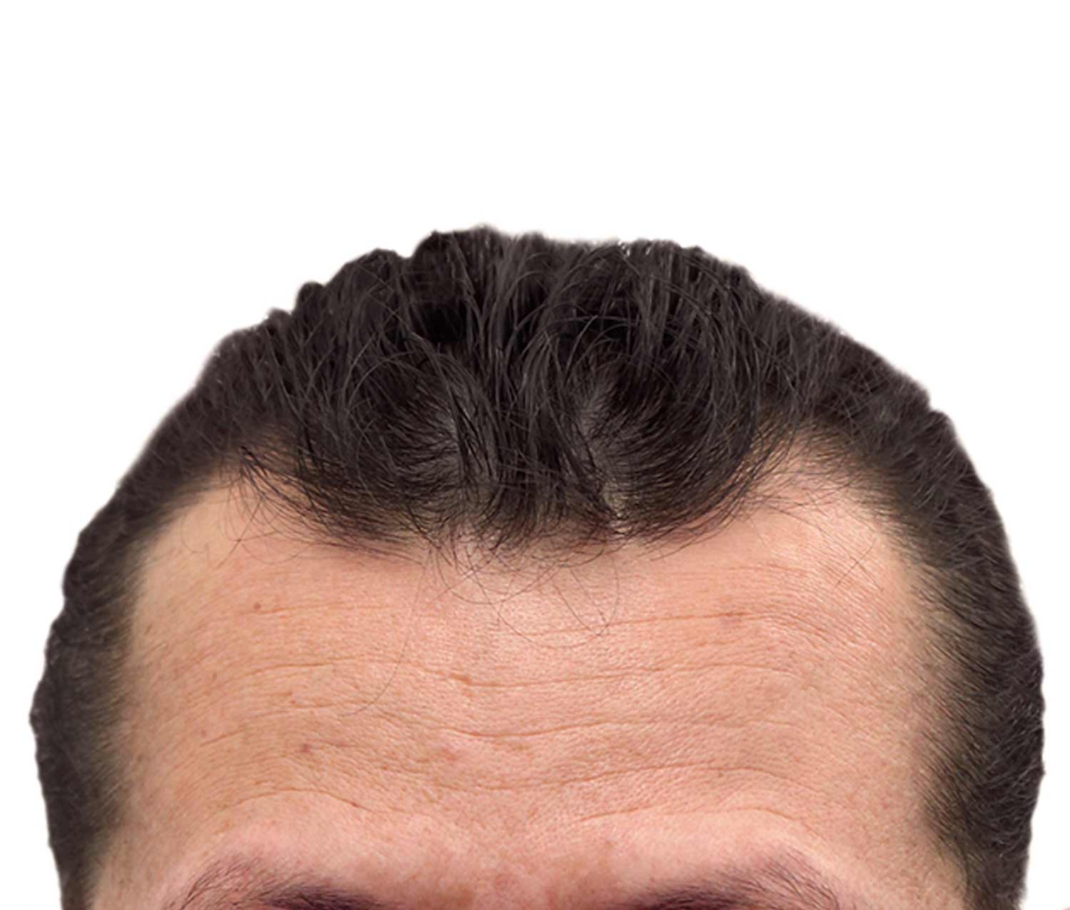 Before hair restoration | Real patient, results may vary per individual