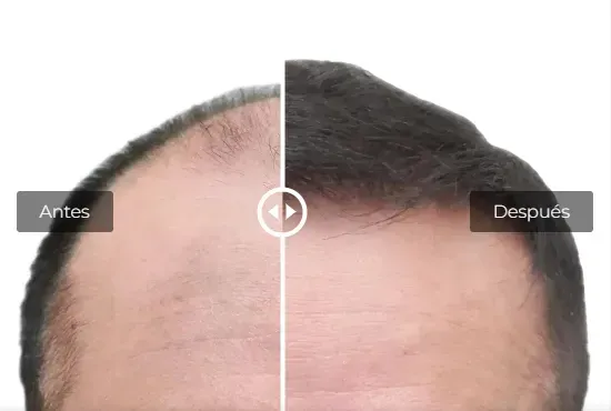 Se muestra la cabeza de un hombre antes y después de un trasplante de cabello.