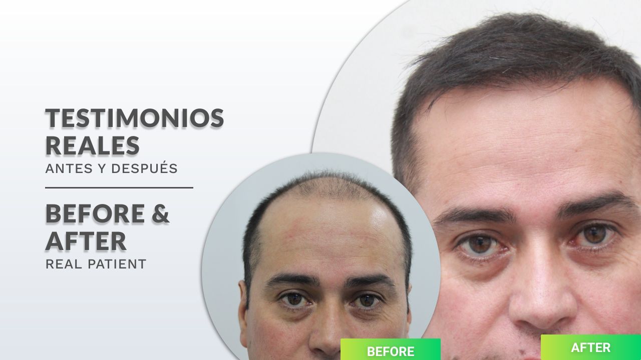 Emilio | Paciente Real | Resultados Reales