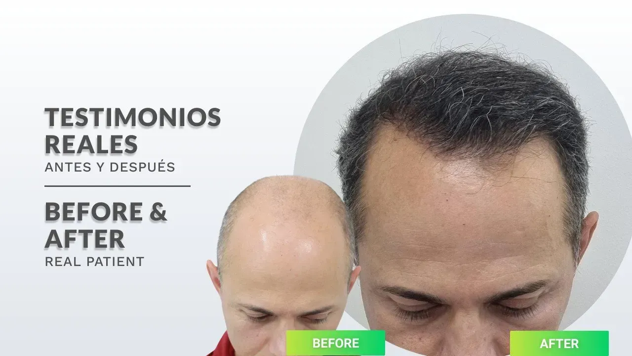 a man 's head is shown before and after a hair transplant .