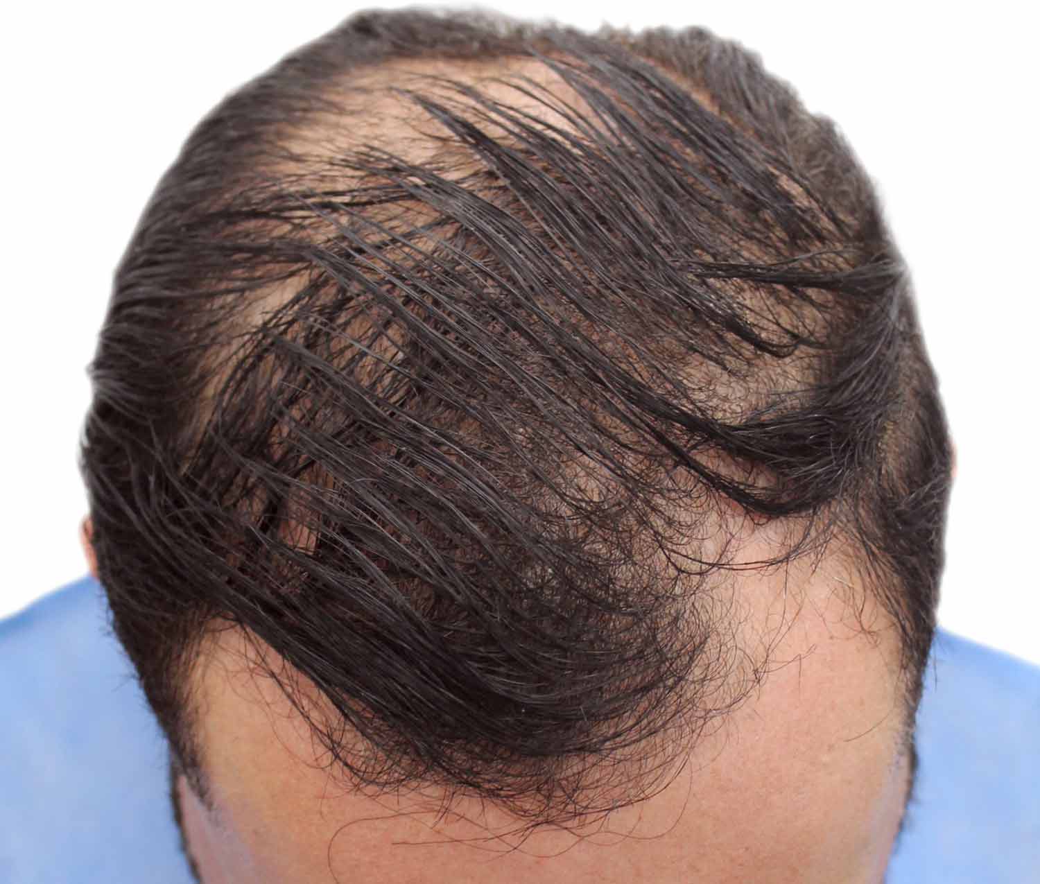 Before hair restoration | Real patient, results may vary per individual