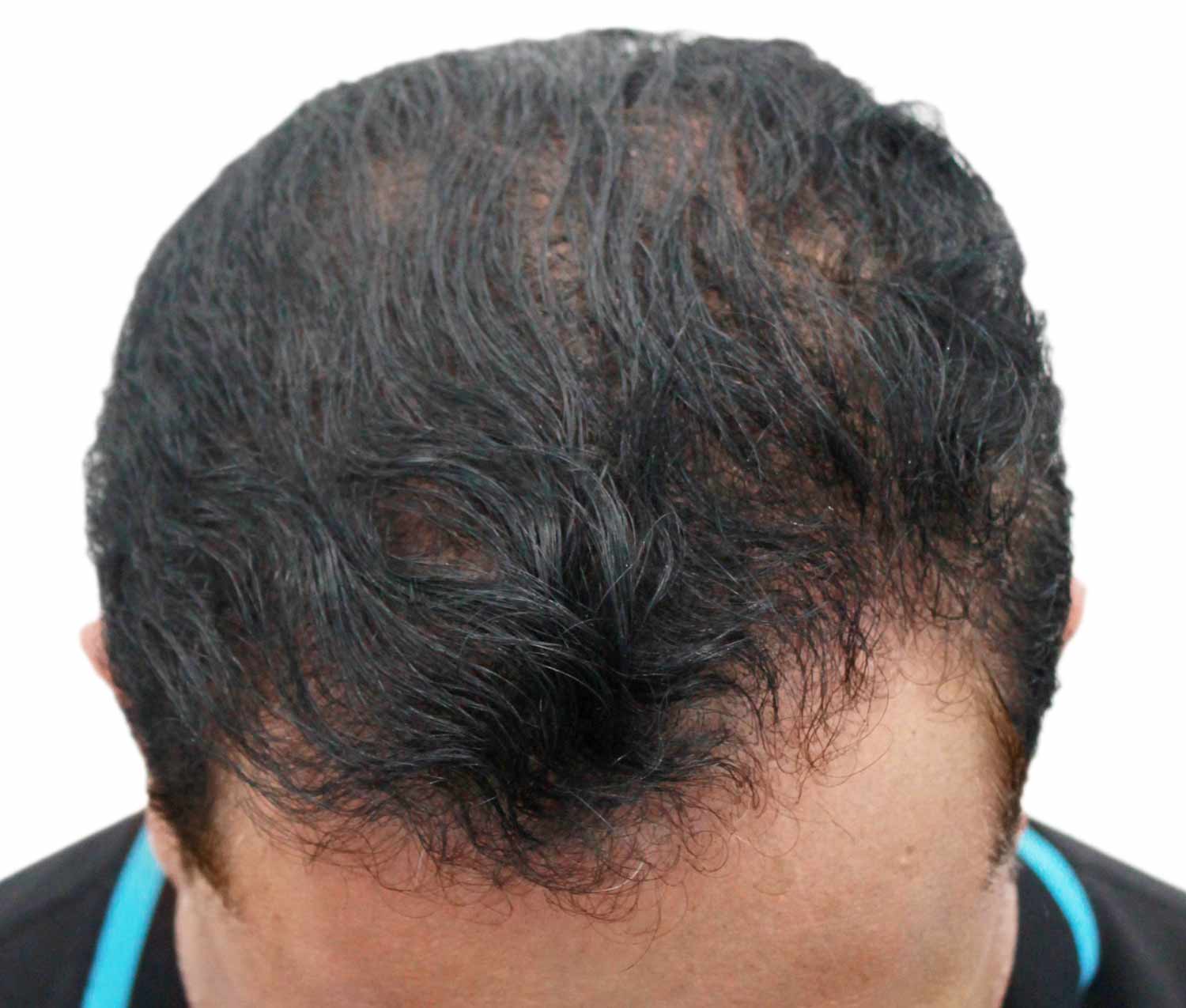 After hair restoration | Real patient, results may vary per individual
