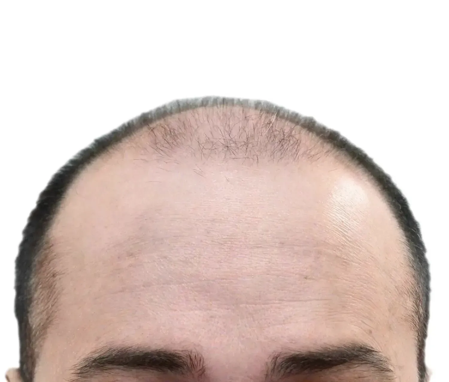 Hombre antes de un trasplante capilar