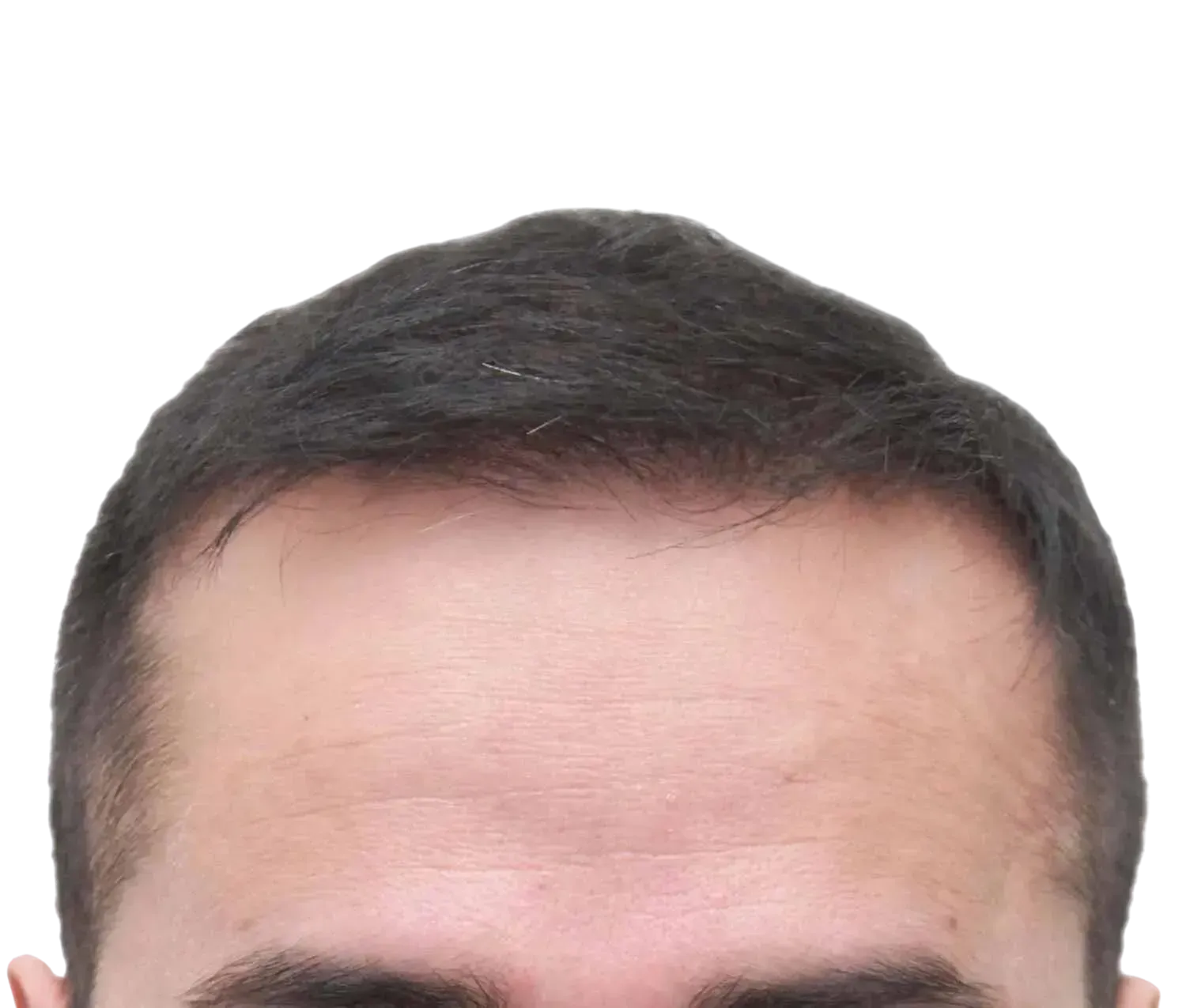 Después de trasplante capilar | Paciente real Resultado Real
