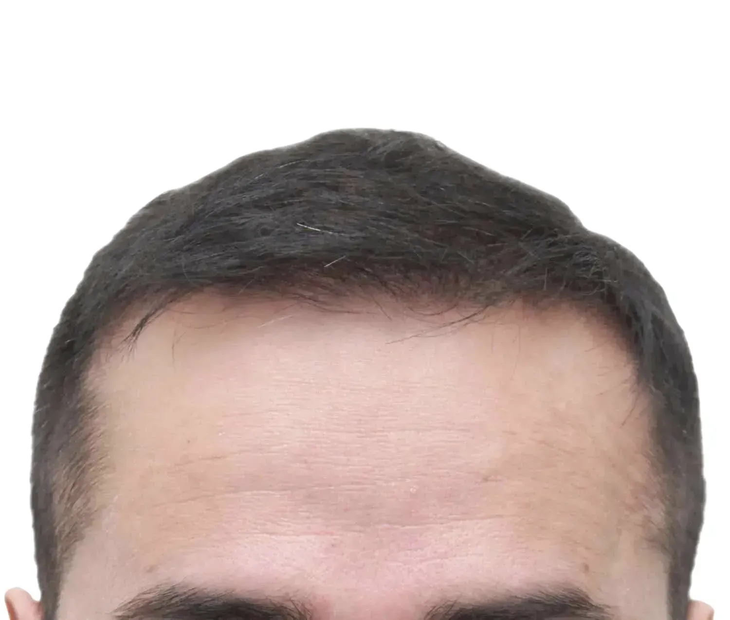 Hombre después de un trasplante capilar