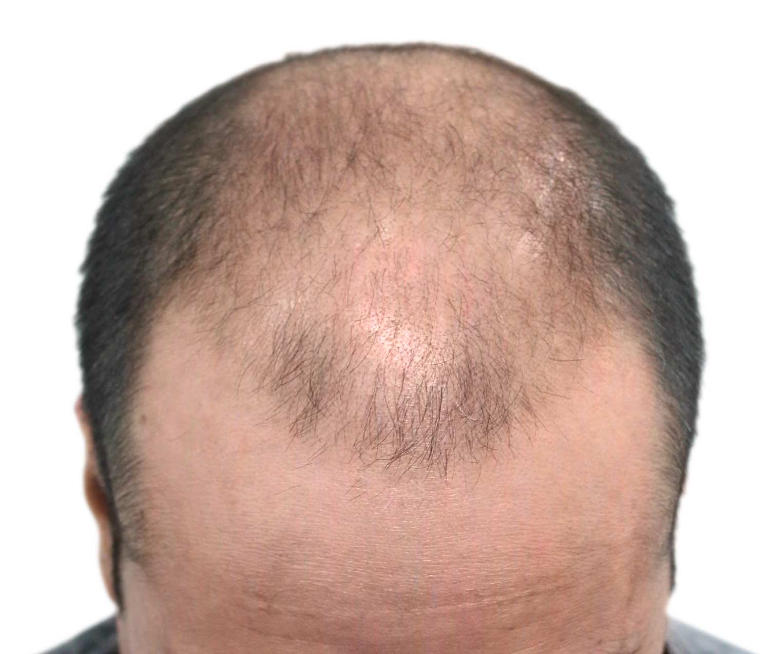 Before hair restoration | Real patient, results may vary per individual