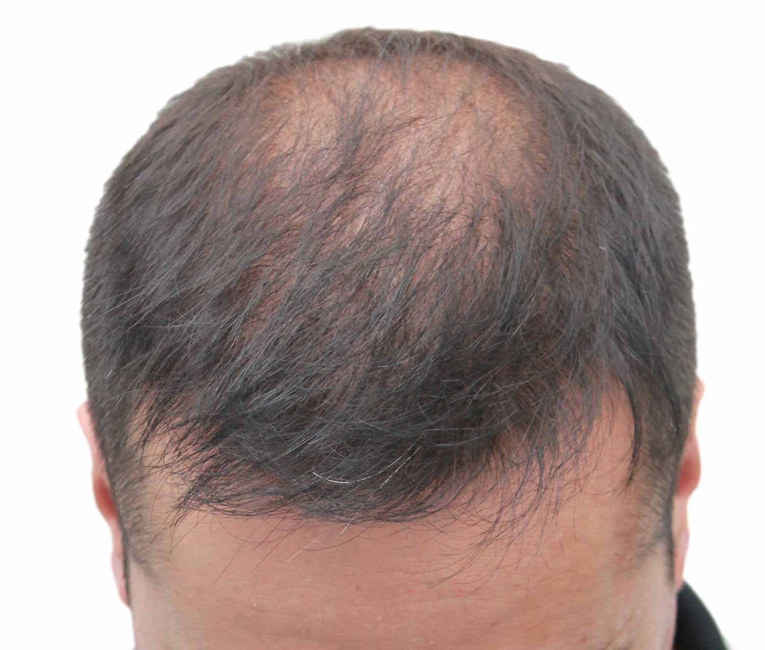 After hair restoration | Real patient, results may vary per individual
