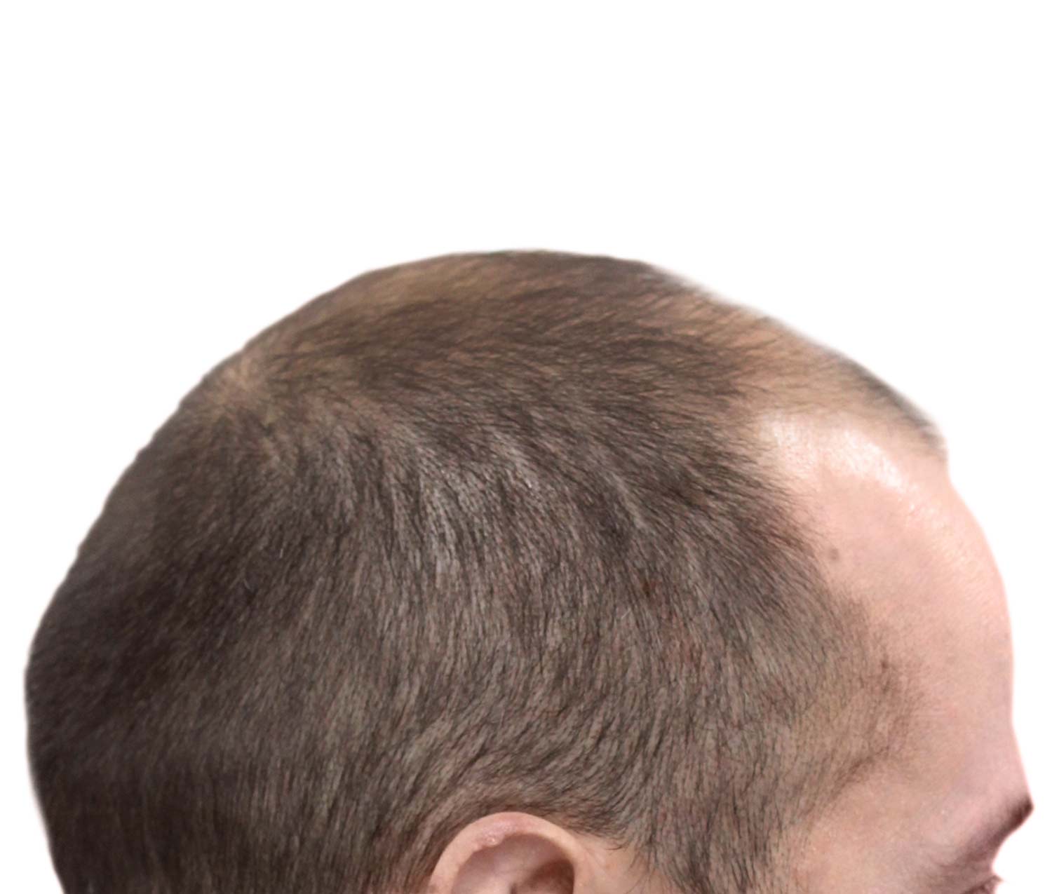 Before hair restoration | Real patient, results may vary per individual
