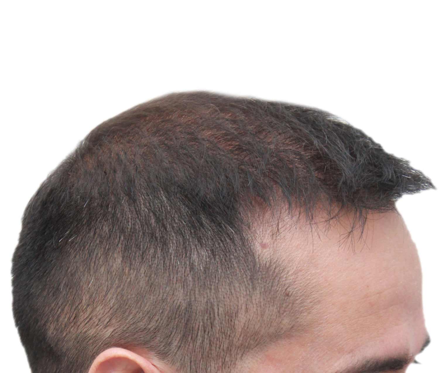 After hair restoration | Real patient, results may vary per individual