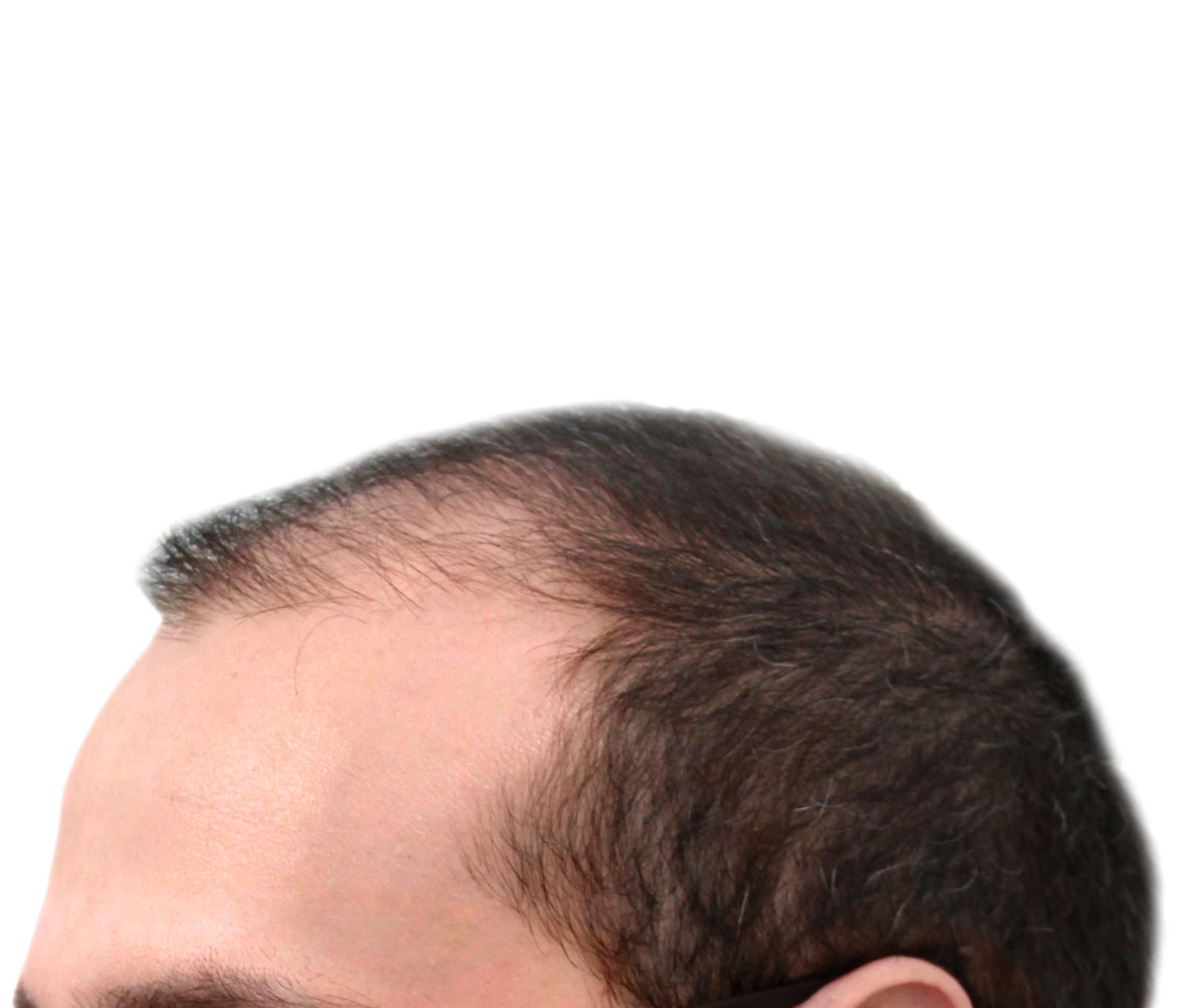 Before hair restoration | Real patient, results may vary per individual