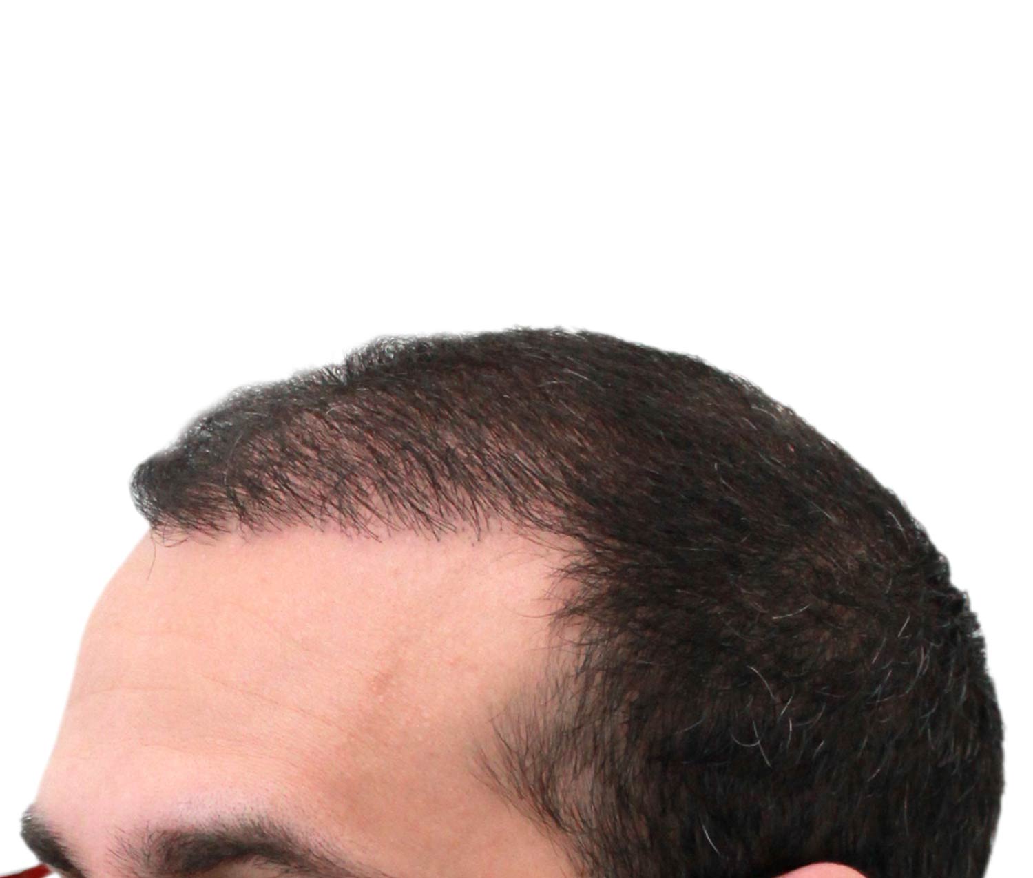 After hair restoration | Real patient, results may vary per individual