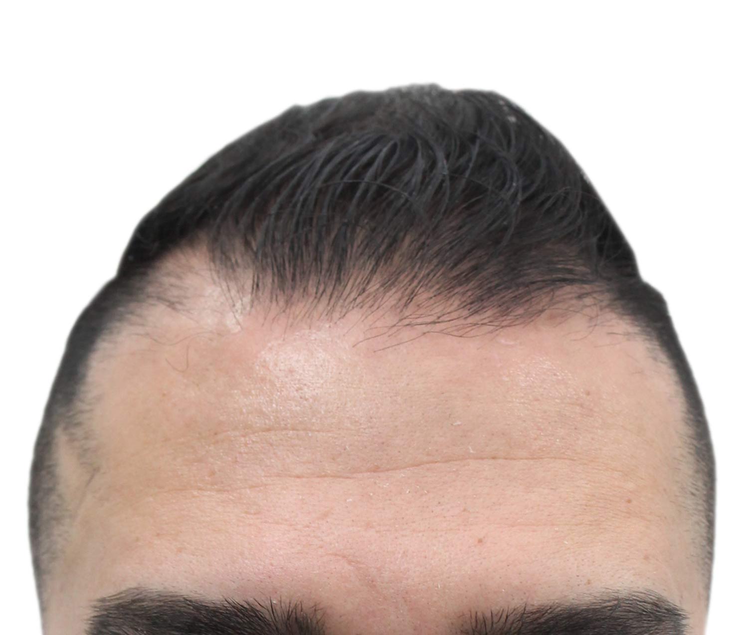 Before Hair Restoration