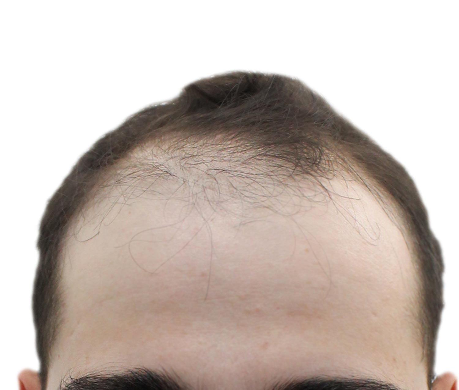 Before hair restoration | Real patient, results may vary per individual