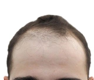 hombre antes de trasplante capilar