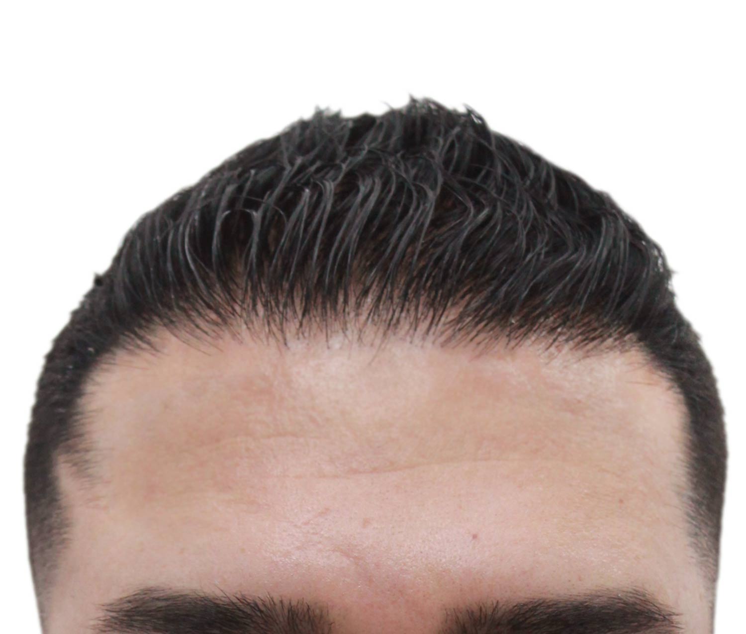Before Hair Restoration