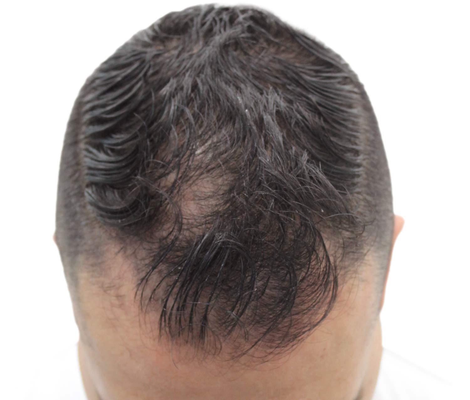 Before hair restoration | Real patient, results may vary per individual