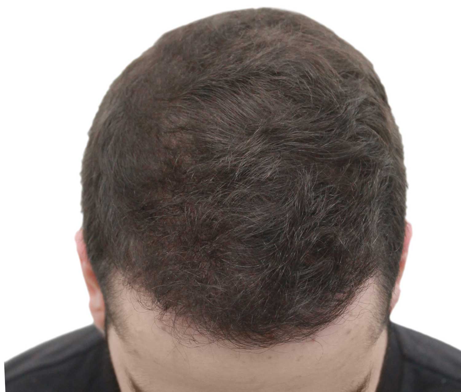After hair restoration | Real patient, results may vary per individual