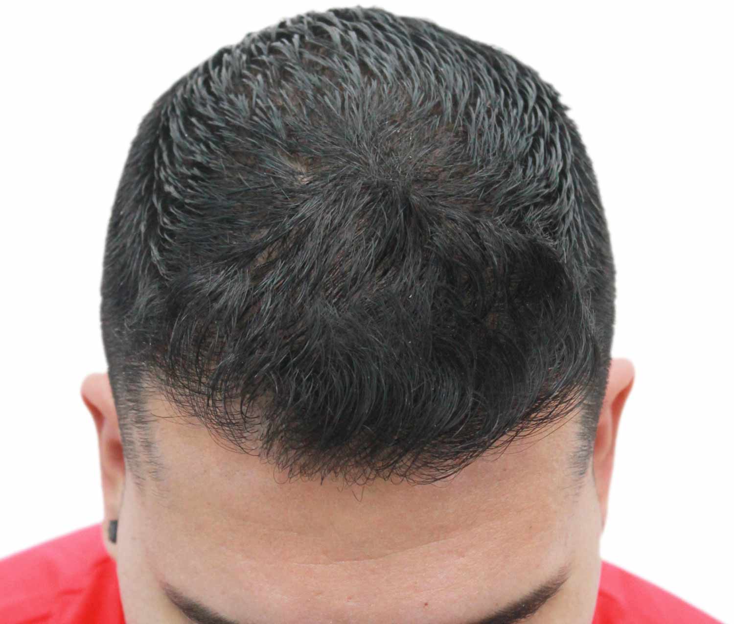 After hair restoration | Real patient, results may vary per individual