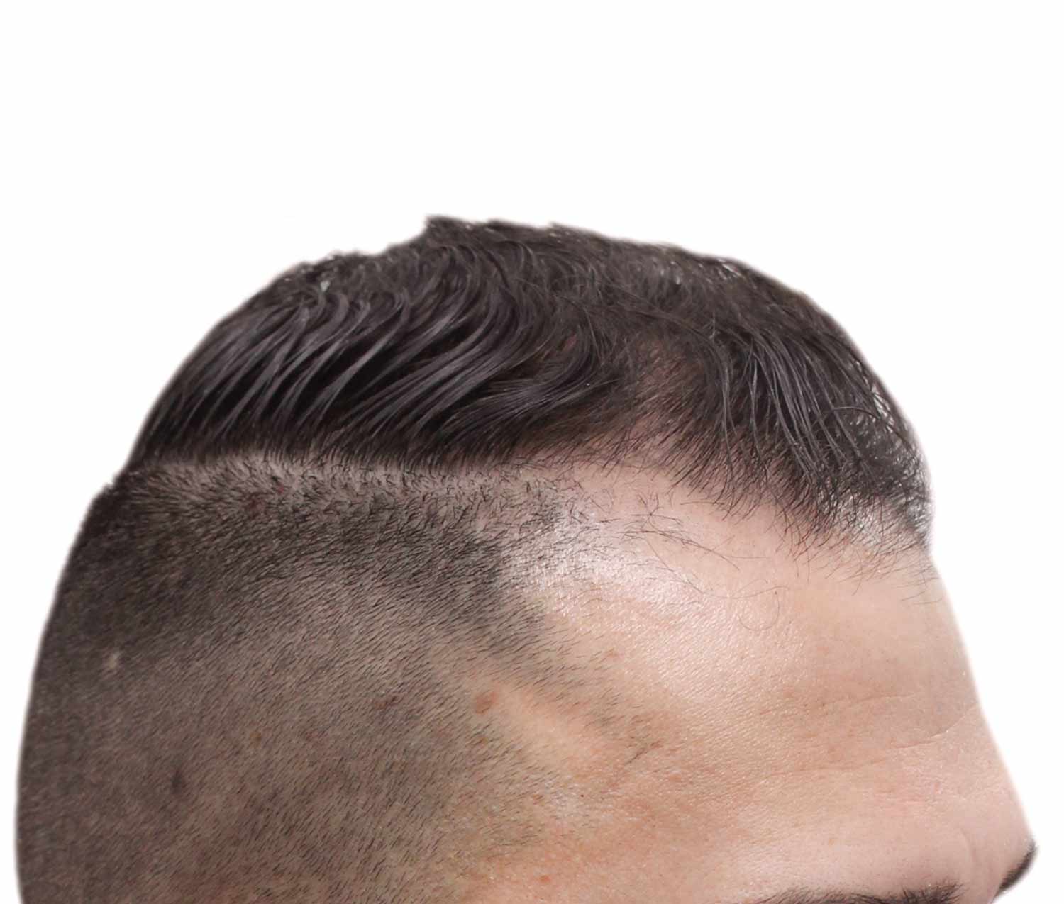 Before hair restoration | Real patient, results may vary per individual