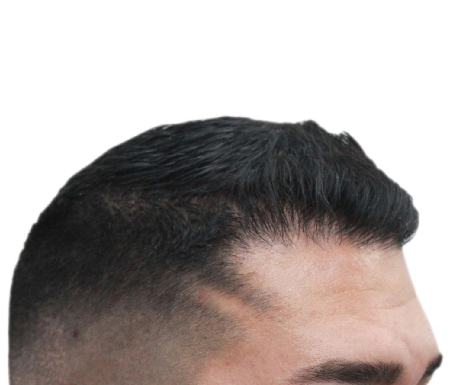 After hair restoration | Real patient, results may vary per individual