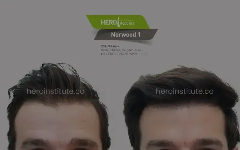 before and after hair transplant