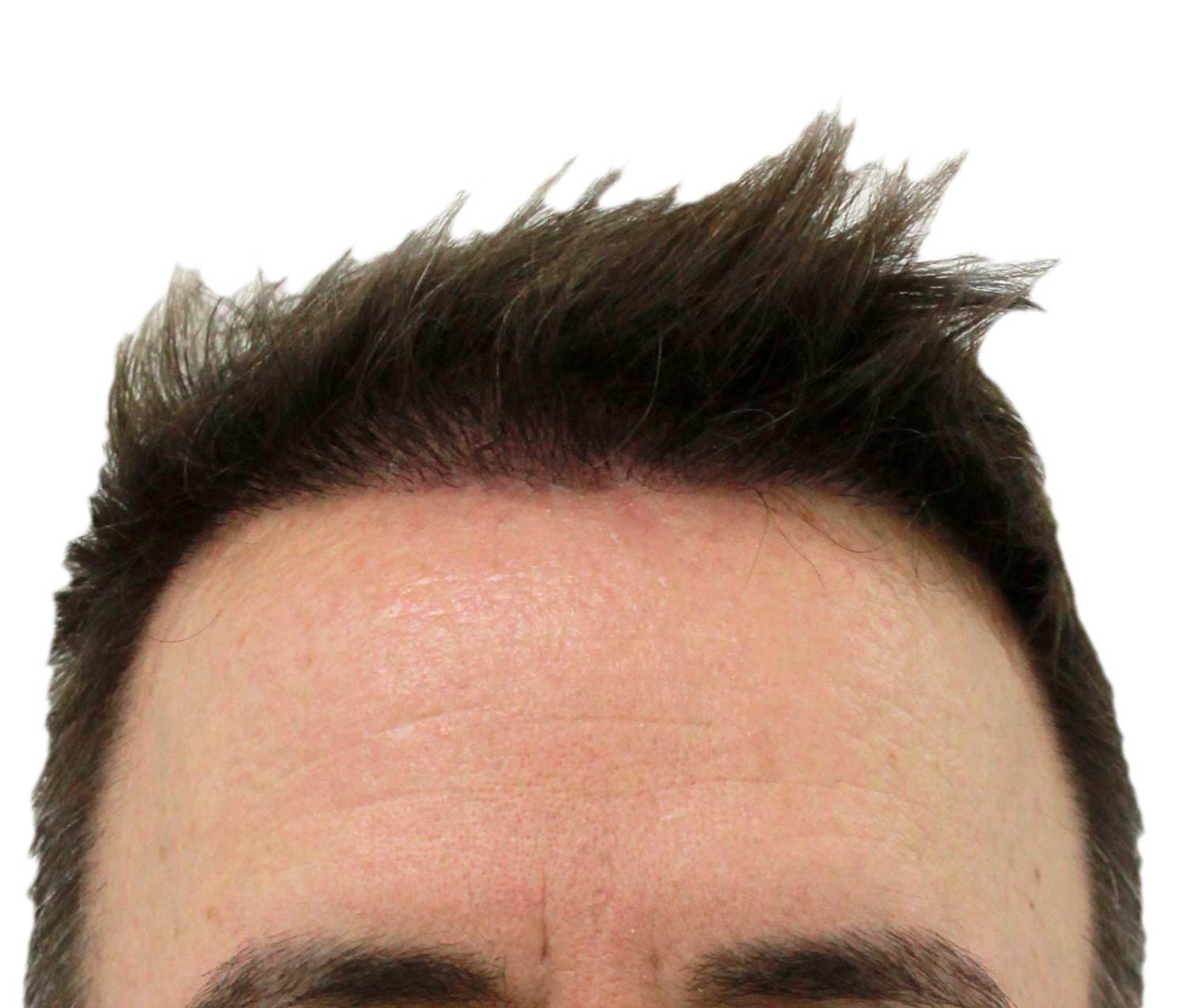 After hair restoration | Real patient, results may vary per individual