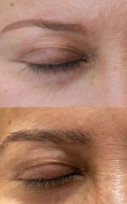Eyebrow trasplant