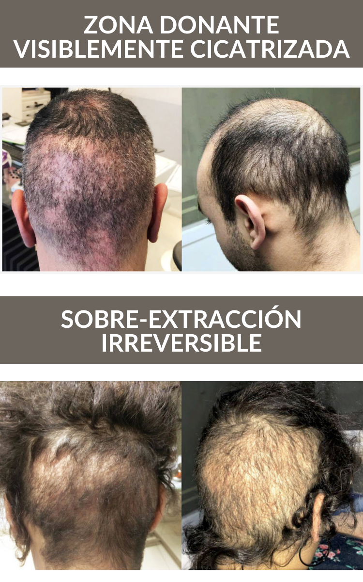 sobre-extraccion irreversible peligros de un trasplante capilar