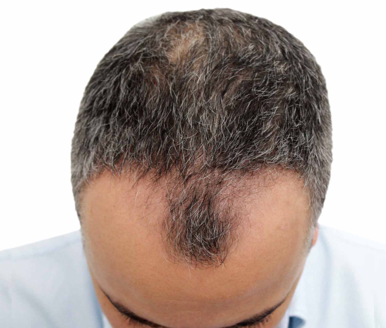 Before hair restoration | Real patient, results may vary per individual